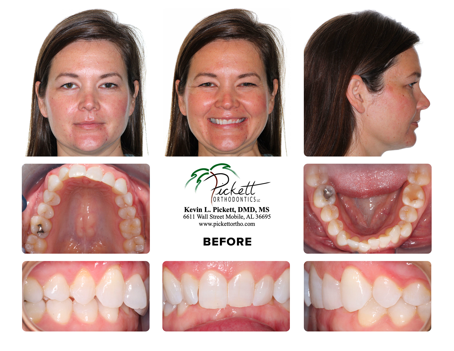 How Personalizing Your Smile Line Makes a World of Difference